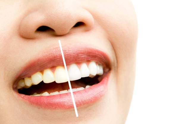 solar Dental TX teeth whitening