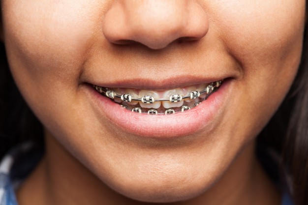 A girl wears braces