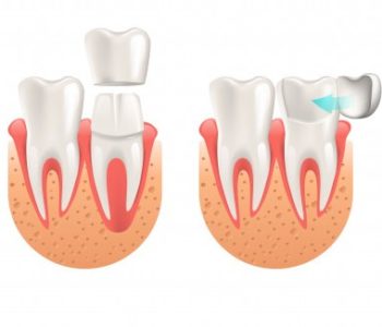teeth-procedure-implant-veneer-crown-restoration