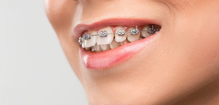 A woman wearing braces