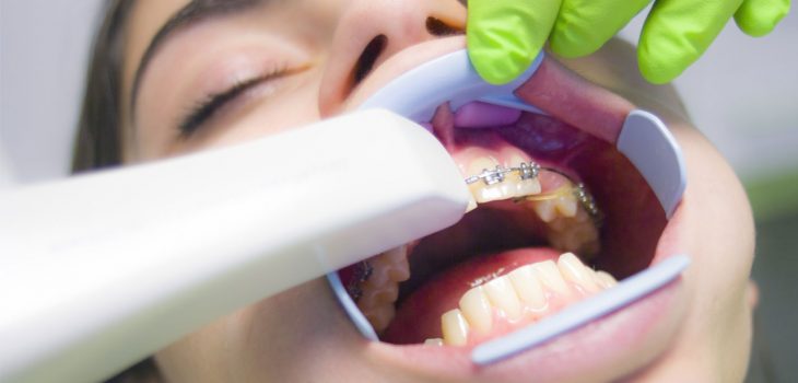 Dentist putting braces on a child